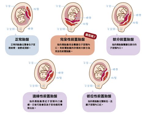 胎盤前置|前置胎盤有4種，一張圖帶你秒懂｜Mombaby 媽媽寶 